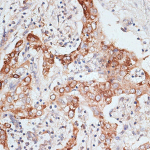 Immunohistochemistry of paraffin-embedded Human liver cancer using PIGR Polyclonal Antibody at dilution of 1:100 (40x lens) .
