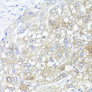 Immunohistochemistry of paraffin-embedded Human liver cancer using ASL Polyclonal Antibody at dilution of 1:100 (40x lens) .