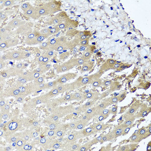 Immunohistochemistry of paraffin-embedded Human liver damage using MGAT1 Polyclonal Antibody at dilution of 1:100 (40x lens) .