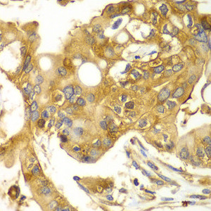 Immunohistochemistry of paraffin-embedded Human liver cancer using CAPNS1 Polyclonal Antibody at dilution of 1:100 (40x lens) .