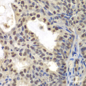 Immunohistochemistry of paraffin-embedded Human oophoroma using CENPC Polyclonal Antibody at dilution of 1:200 (40x lens) .