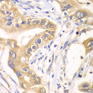 Immunohistochemistry of paraffin-embedded Human liver cancer using HAGH Polyclonal Antibody at dilution of 1:100 (40x lens) .