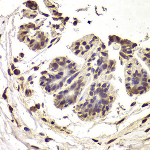 Immunohistochemistry of paraffin-embedded Human breast cancer using INTS6 Polyclonal Antibody at dilution of 1:100 (40x lens) .