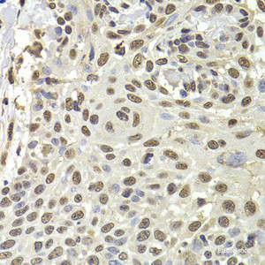 Immunohistochemistry of paraffin-embedded Human well-differentiated squamous skin carcinoma using PUF60 Polyclonal Antibody at dilution of 1:100 (40x lens) .