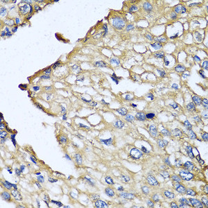 Immunohistochemistry of paraffin-embedded Human prostate cancer using ASIP Polyclonal Antibody at dilution of 1:100 (40x lens) .