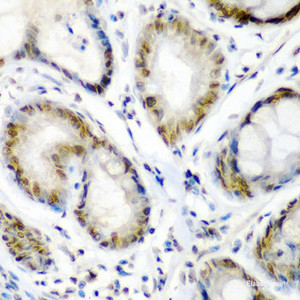 Immunohistochemistry of paraffin-embedded Human colon carcinoma using SS18 Polyclonal Antibody at dilution of 1:200 (40x lens) .
