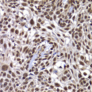 Immunohistochemistry of paraffin-embedded Human well-differentiated squamous skin carcinoma using DNAJB6 Polyclonal Antibody at dilution of 1:100 (40x lens) .