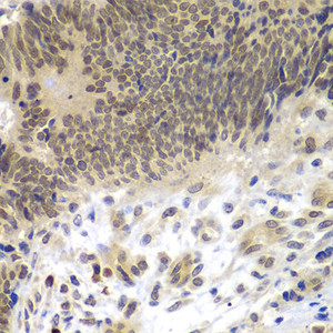Immunohistochemistry of paraffin-embedded Human colon carcinoma using CEBPG Polyclonal Antibody at dilution of 1:100 (40x lens) .