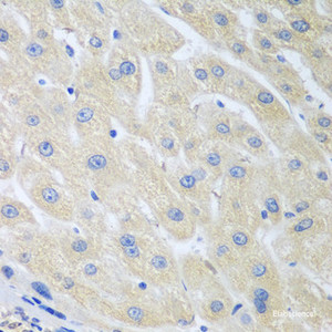 Immunohistochemistry of paraffin-embedded Human liver cancer using PON1 Polyclonal Antibody at dilution of 1:100 (40x lens) .