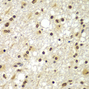 Immunohistochemistry of paraffin-embedded Human brain cancer using ZNF20 Polyclonal Antibody at dilution of 1:100 (40x lens) .