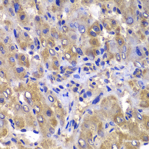 Immunohistochemistry of paraffin-embedded Human liver damage using CARD10 Polyclonal Antibody at dilution of 1:100 (40x lens) .