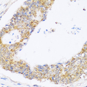 Immunohistochemistry of paraffin-embedded Human colon carcinoma using ZAK Polyclonal Antibody at dilution of 1:100 (40x lens) .
