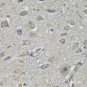 Immunohistochemistry of paraffin-embedded Human brain cancer using WIPI1 Polyclonal Antibody at dilution of 1:100 (40x lens) .