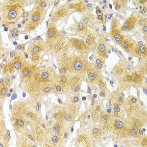Immunohistochemistry of paraffin-embedded Human liver damage using EIF4G1 Polyclonal Antibody at dilution of 1:100 (40x lens) .