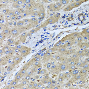 Immunohistochemistry of paraffin-embedded Human liver damage using UGT2B10 Polyclonal Antibody at dilution of 1:100 (40x lens) .