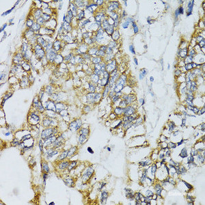 Immunohistochemistry of paraffin-embedded Human gastric cancer using ECSIT Polyclonal Antibody at dilution of 1:100 (40x lens) .