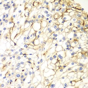 Immunohistochemistry of paraffin-embedded Human kidney cancer using VANGL2 Polyclonal Antibody at dilution of 1:100 (40x lens) .