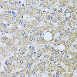 Immunohistochemistry of paraffin-embedded Human liver damage using AARS2 Polyclonal Antibody at dilution of 1:100 (40x lens) .