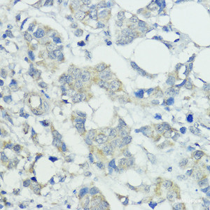 Immunohistochemistry of paraffin-embedded Human mammary cancer using SOCS5 Polyclonal Antibody at dilution of 1:100 (40x lens) .