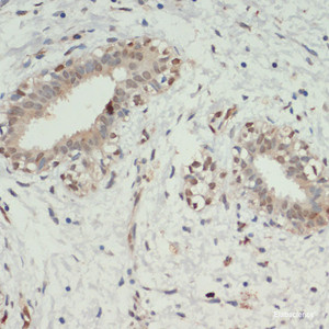 Immunohistochemistry of paraffin-embedded Human breast cancer using KDM6A Polyclonal Antibody at dilution of 1:200 (40x lens) .