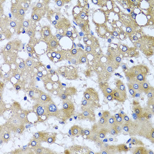 Immunohistochemistry of paraffin-embedded Human liver damage using TTLL12 Polyclonal Antibody at dilution of 1:100 (40x lens) .
