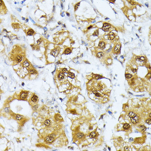 Immunohistochemistry of paraffin-embedded Human liver cancer using RRAGD Polyclonal Antibody at dilution of 1:100 (40x lens) .
