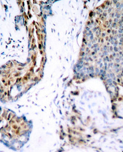 Immunohistochemistry of paraffin-embedded Human breast carcinoma using Phospho-Estrogen Receptor alpha（S118） Polyclonal Antibody