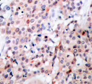 Immunohistochemistry of paraffin-embedded Human breast carcinoma tissue, using Phospho-Bcl-2 (T56) Polyclonal Antibody