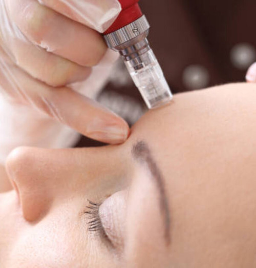 Microneedling