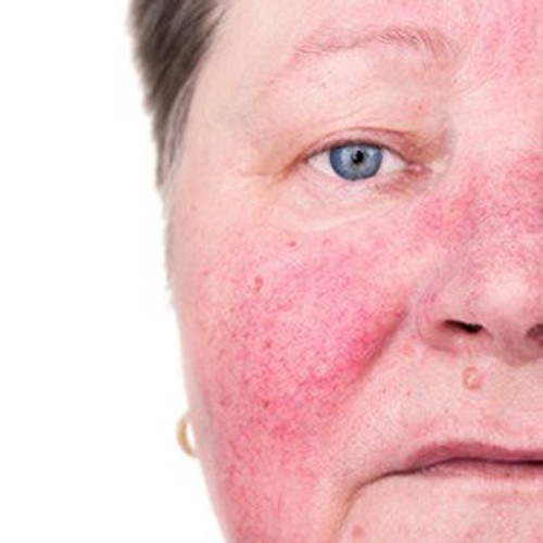 Rosacea Therapy