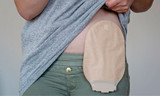 Best Practices for Living With an Ostomy Bag
