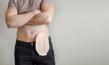 What Are the Different Types of Ostomy Bags?