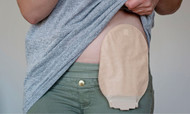Best Practices for Living With an Ostomy Bag
