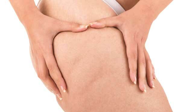 Cellulite