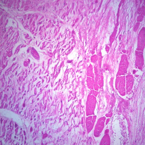 Human Myocardial Infarct, Old, sec. 7 µm, H&E Microscope Slide