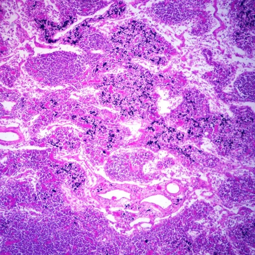 Human Anthracosis in Lymph Node Slide, 7 µm, H&E