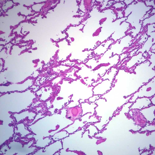 Human Pulmonary Hypertension, sec. 7 µm H&E Microscope Slide