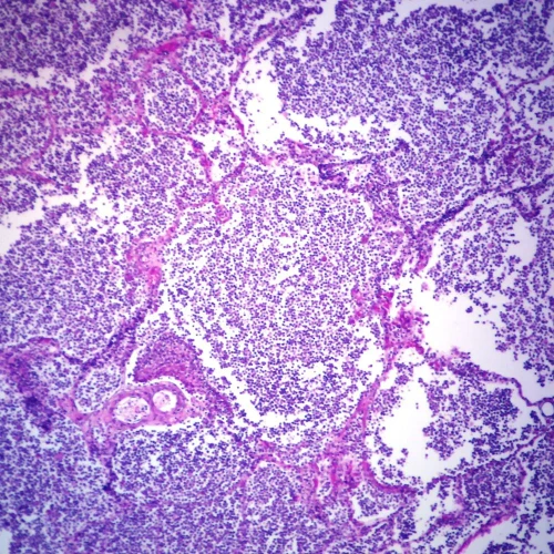 Lobar Pneumonia, Microscope Slide