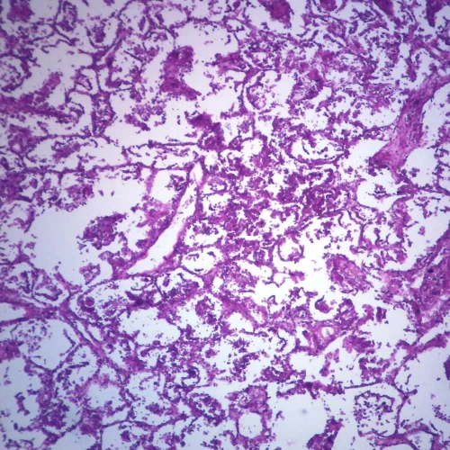Human Bronchopneumonia, sec. 7 µm H&E Microscope Slide
