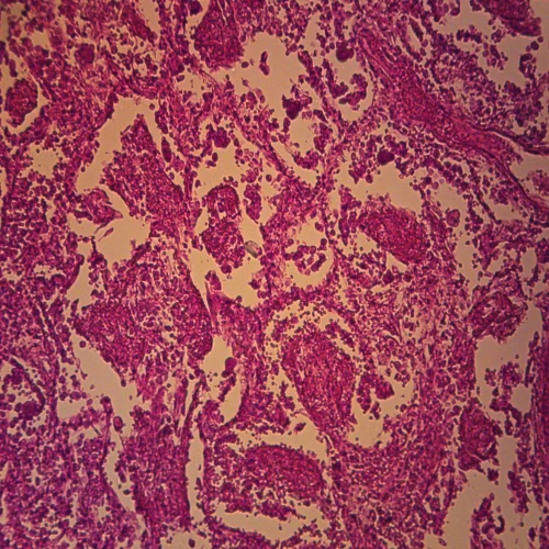 Human Viral Pneumonia, Lung, sec. 7 µm H&E Microscope Slide
