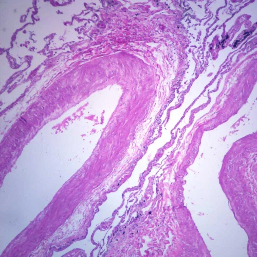 Human Bronchogenic Carcinoma, sec. 7 µm H&E Microscope Slide