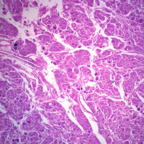 Human Pulmonary Emphysema, sec. 7 µm H&E Microscope Slide