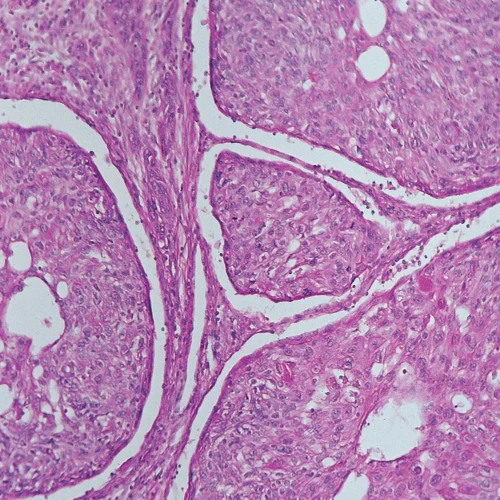 Human Carcinoma of Esophagus, sec. 7 µm, H&E Microscope Slide