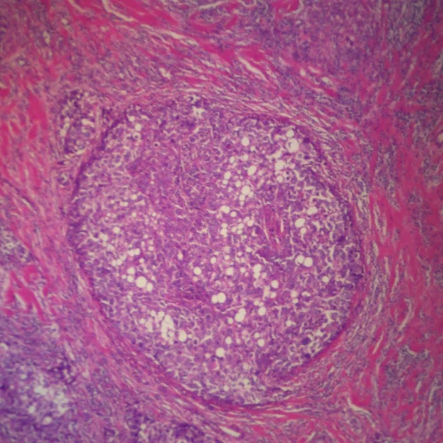 Human Acute Suppurative Appendicitis, sec. 7 µm H&E Microscope Slide