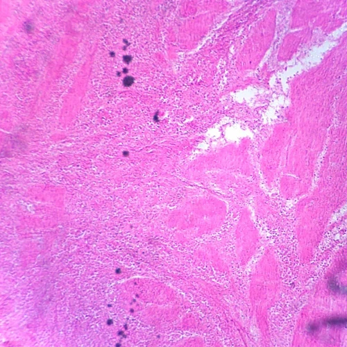Human Carcinoma of Stomach, sec. 7 µm H&E Microscope Slide