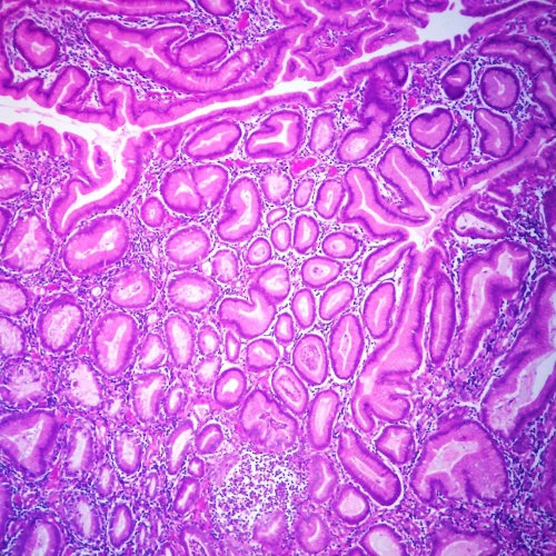 Villous Adenoma Colon, Microscope Slide