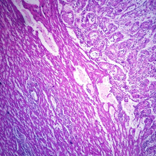 Human Metastatic Carcinoma to Liver, sec. 7 µm H&E Microscope Slide.