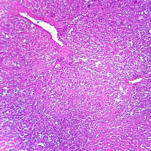 Human Liver with Hepatitis, sec. 7 µm H&E Microscope Slide.