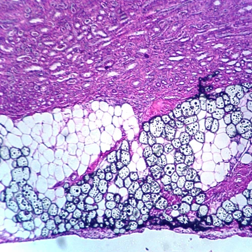Human Adenocarcinoma of Kidney, sec. 7 µm, H&E Microscope Slide