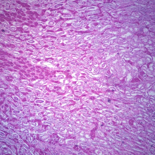 Chronic Pyelonephritis, Microscope Slide